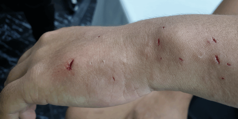 Dog bite wounds on a person's hand, wrist, and forearm | Daniel Stark Injury Lawyers