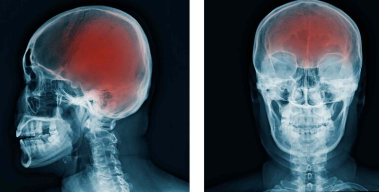Profile and front view X-rays showing traumatic brain injury areas highlighted in red | Daniel Stark Injury Lawyers